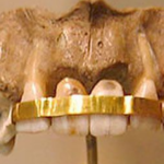 The History of Braces