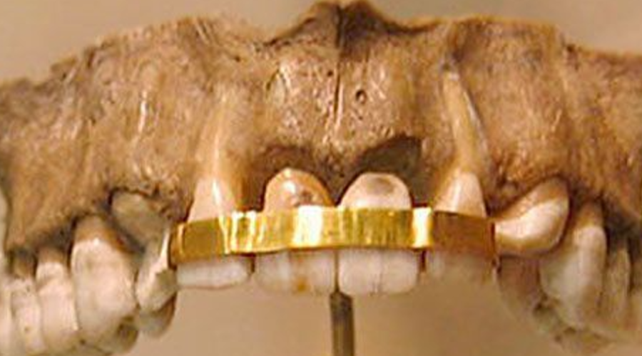 The History of Braces