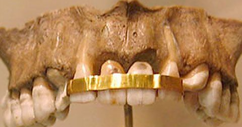 The History of Braces We Heart World